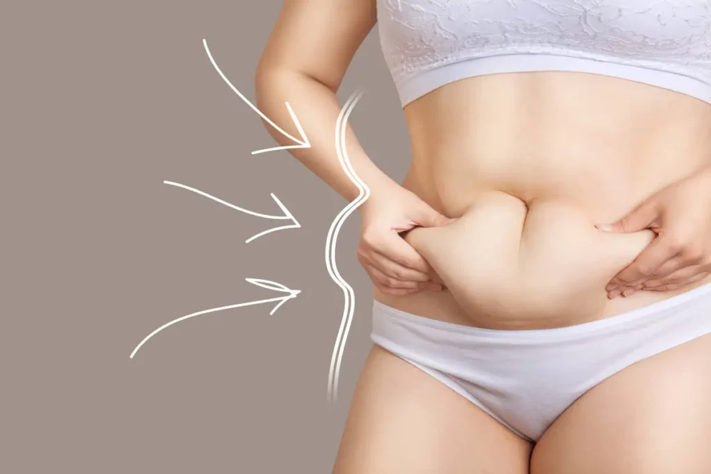 Tummy Tucks by Dr. Leonard Grossman in Brooklyn NY