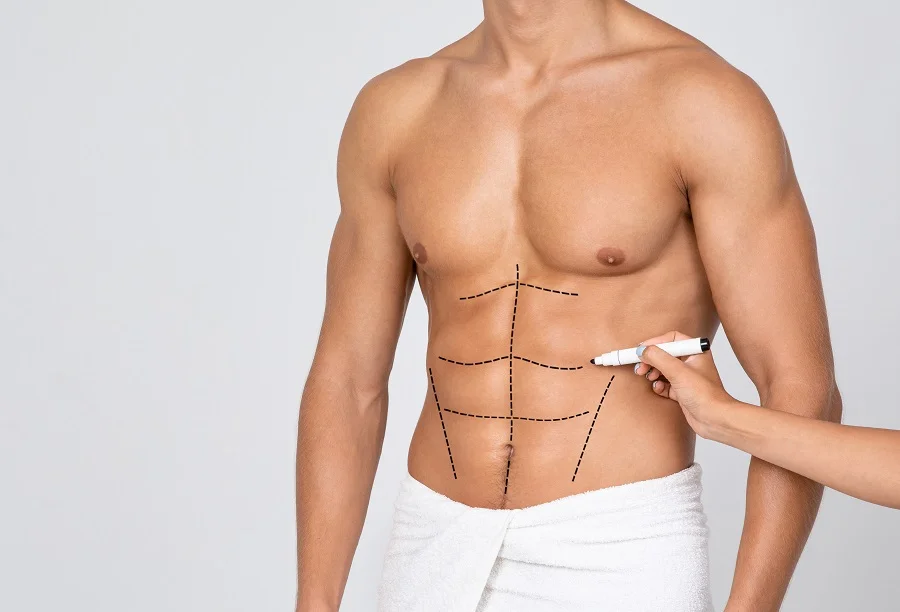 Abdominoplasty and Torsoplasty: Abdominal Liposuction and Removal of the  Apron. the Patient at the Reception at the Plastic Stock Image - Image of  caucasian, medical: 139795341