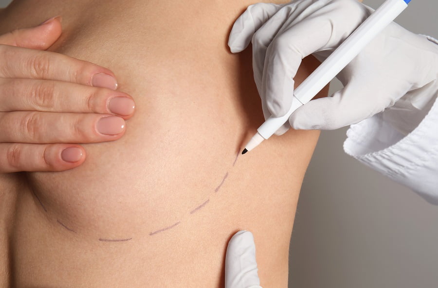 Transumbilical Breast Augmentation (TUBA) | Dr. Leonard Grossman M.D. | NY