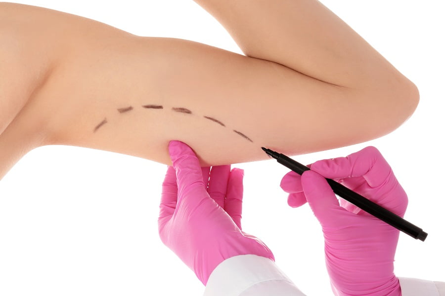 Brachioplasty | Dr. Leonard Grossman M.D. | NY