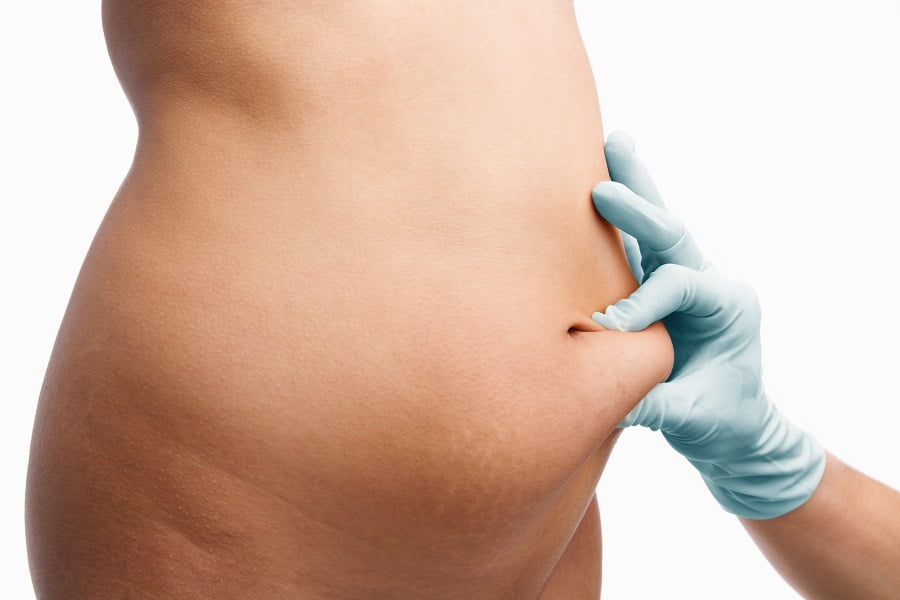 KYBELLA OR LIPOSUCTION | Dr. Leonard Grossman M.D. | NY