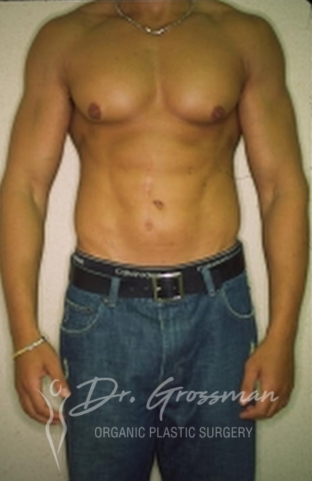 Liposuction 89 2 29
