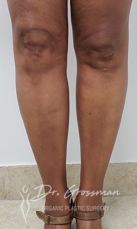 Calf Augmentation with fat | New York City Plastic Surgery PC