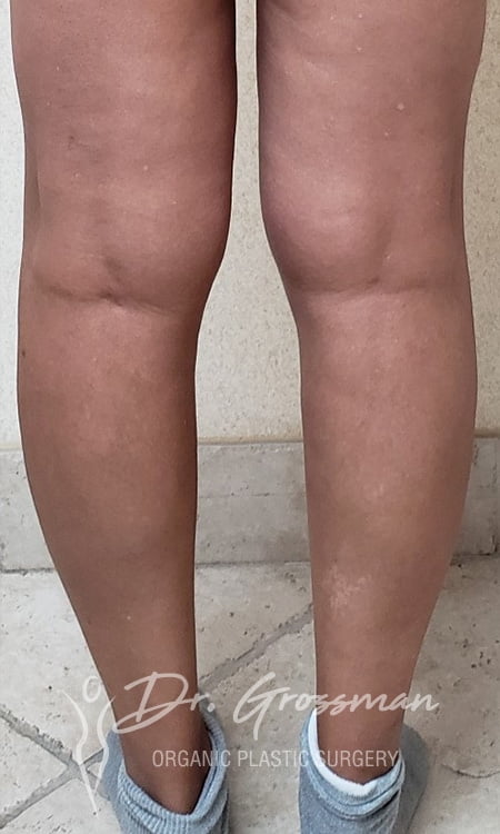 Calf Augmentation with fat | New York City Plastic Surgery PC