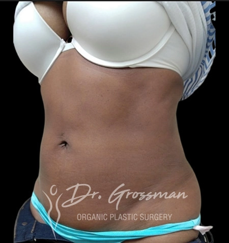 ABDOMINAL LIPO A