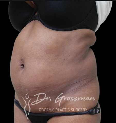 ABDOMINAL LIPO B