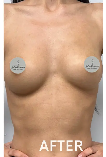 AFTER | Breast Augmentation With Fat NYC