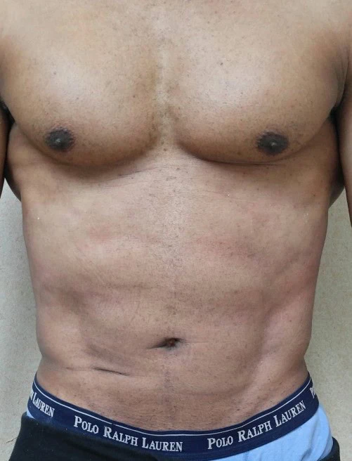 Abdominal Etching Liposuction After by Dr Grossman in NY US