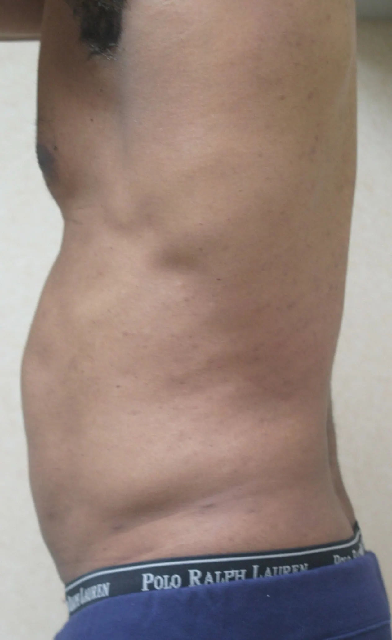 Abdominal Etching Liposuction Before Two by Dr Grossman in NY US