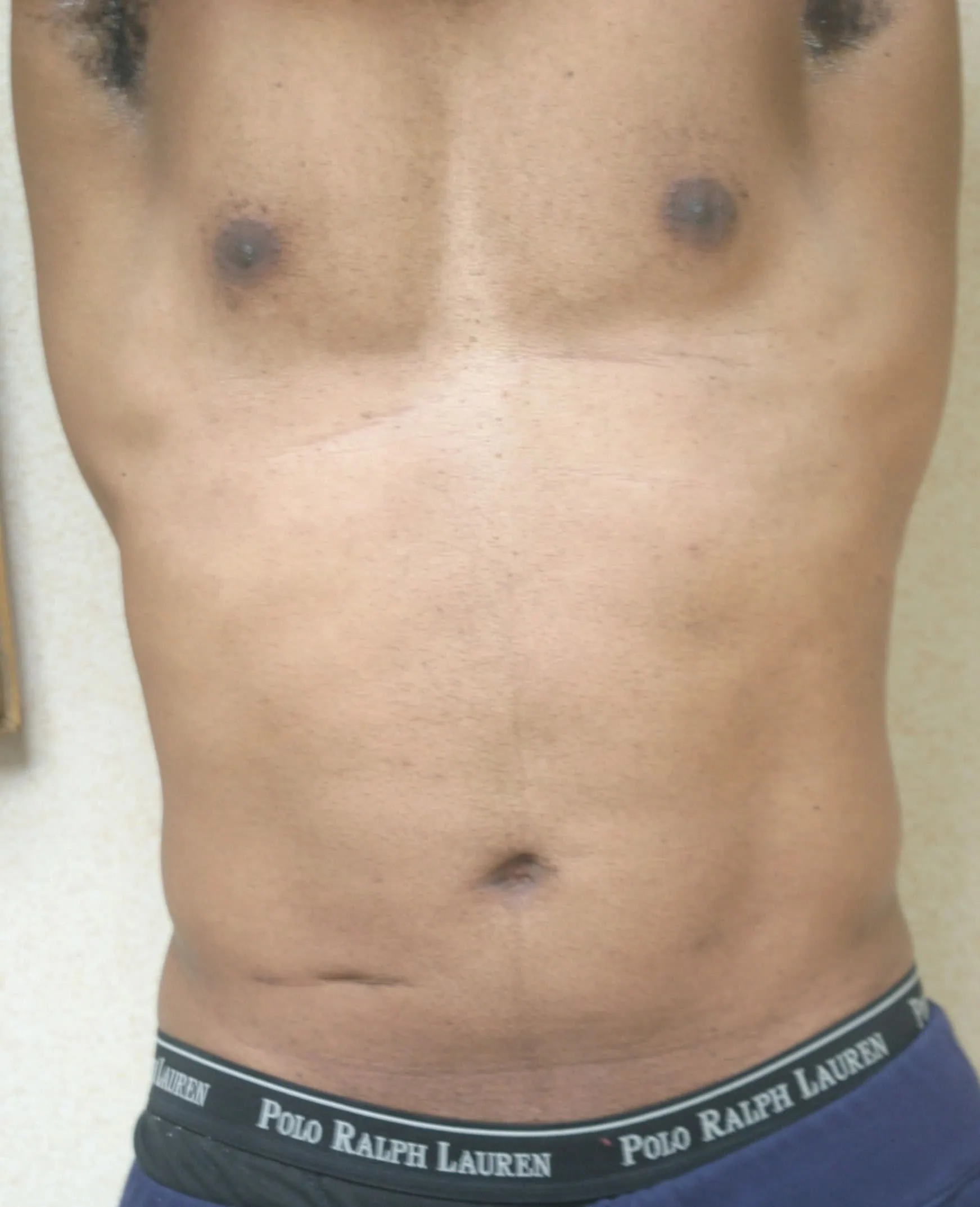 Abdominal Etching Liposuction Before by Dr Grossman in NY US