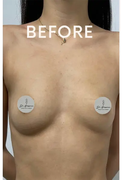 BEFOREN | Breast Augmentation With Fat NYC