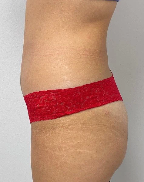 Best Tummy Tuck After Female Side by Dr Grossman in NY US