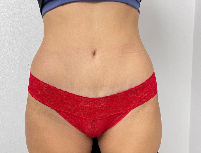 Best Tummy Tuck After Female by Dr Grossman in NY US