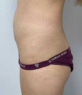 Best Tummy Tuck Before Female Side by Dr Grossman in NY US