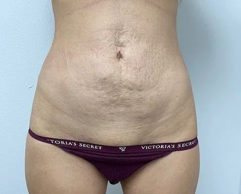 Best Tummy Tuck Before Female by Dr Grossman in NY US