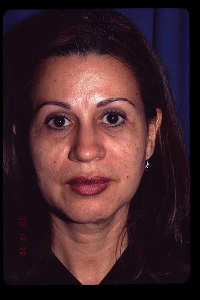 Blepharoplasty After Face Front Full by Dr Grossman in NY US