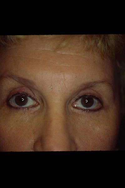 Blepharoplasty After Face Front Half by Dr Grossman in NY US