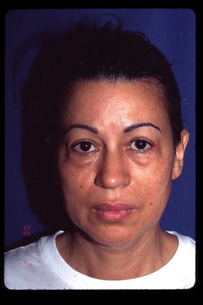 Blepharoplasty Before Face Front Full by Dr Grossman in NY US