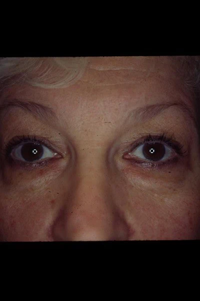 Blepharoplasty Before Face Front Half by Dr Grossman in NY US