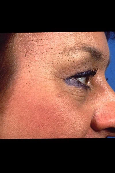 Blepharoplasty Before Face Side Half by Dr Grossman in NY US