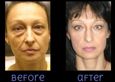 Blepharoplasty Eyelid Lift Before After Two by Dr Grossman in NY US