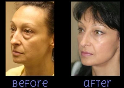 Blepharoplasty Eyelid Lift Before After by Dr Grossman in NY US