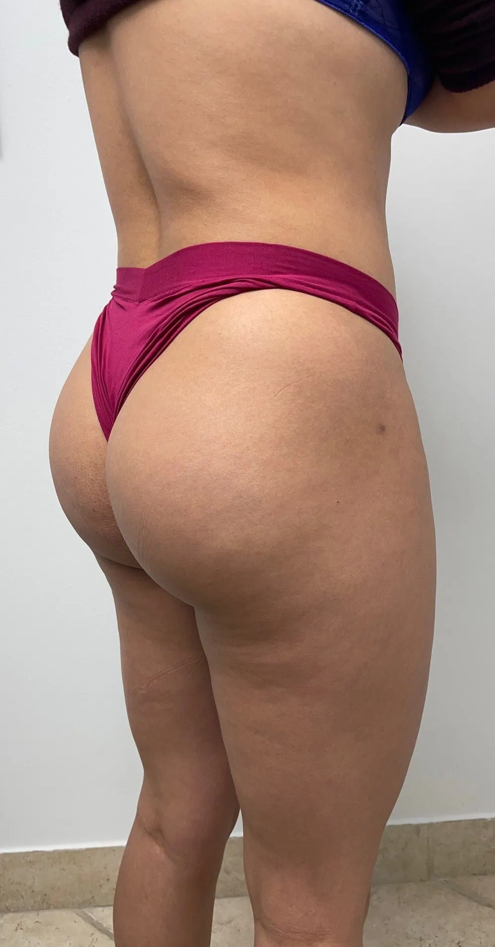 Brazilian Butt Lift After by Dr Grossman in NY US