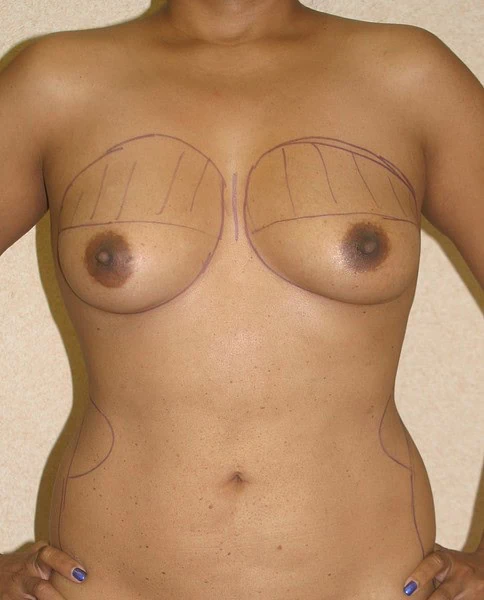 Breast Augmentation With Fat Before Front Female by Dr Grossman in NY US