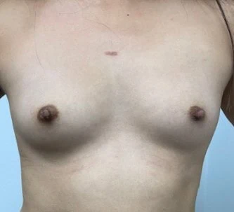 Breast Augmentation With Fat Before by Dr Grossman in NY US 1