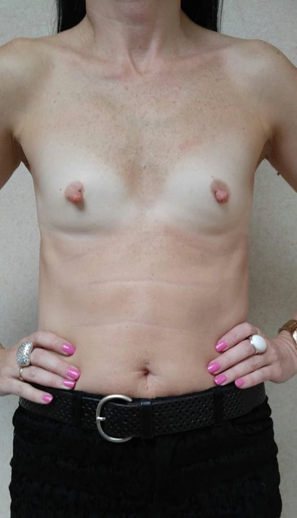 Breast Augmentation With Implants Trans Umbilical Breast Augmentation Before by Dr Grossman in NY US