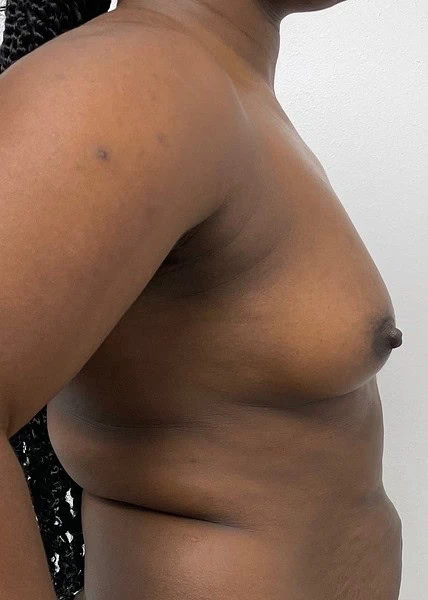 Breast Augmentation With Silicone Gel Before Full Side by Dr Grossman in NY US