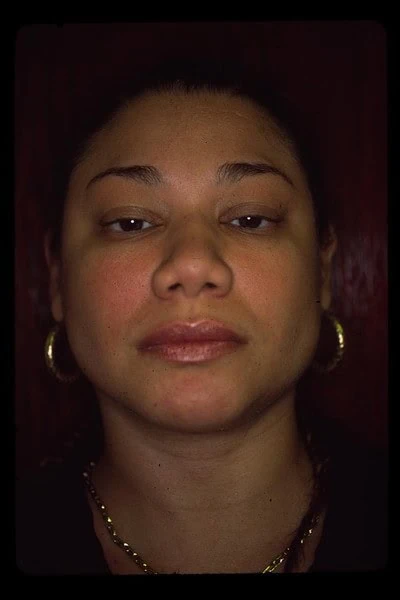 Buccal Fat Removal After Face Front by Dr Grossman in NY US