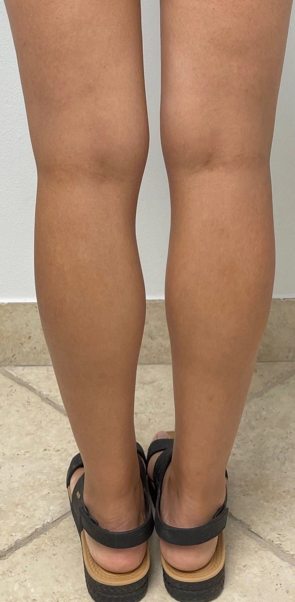 Calf Ankle Liposuction After Three by Dr Grossman in NY US