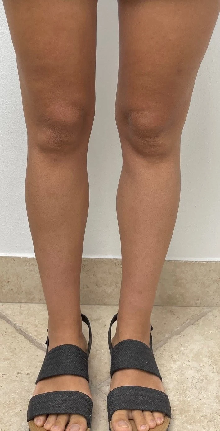 Calf Ankle Liposuction After by Dr Grossman in NY US