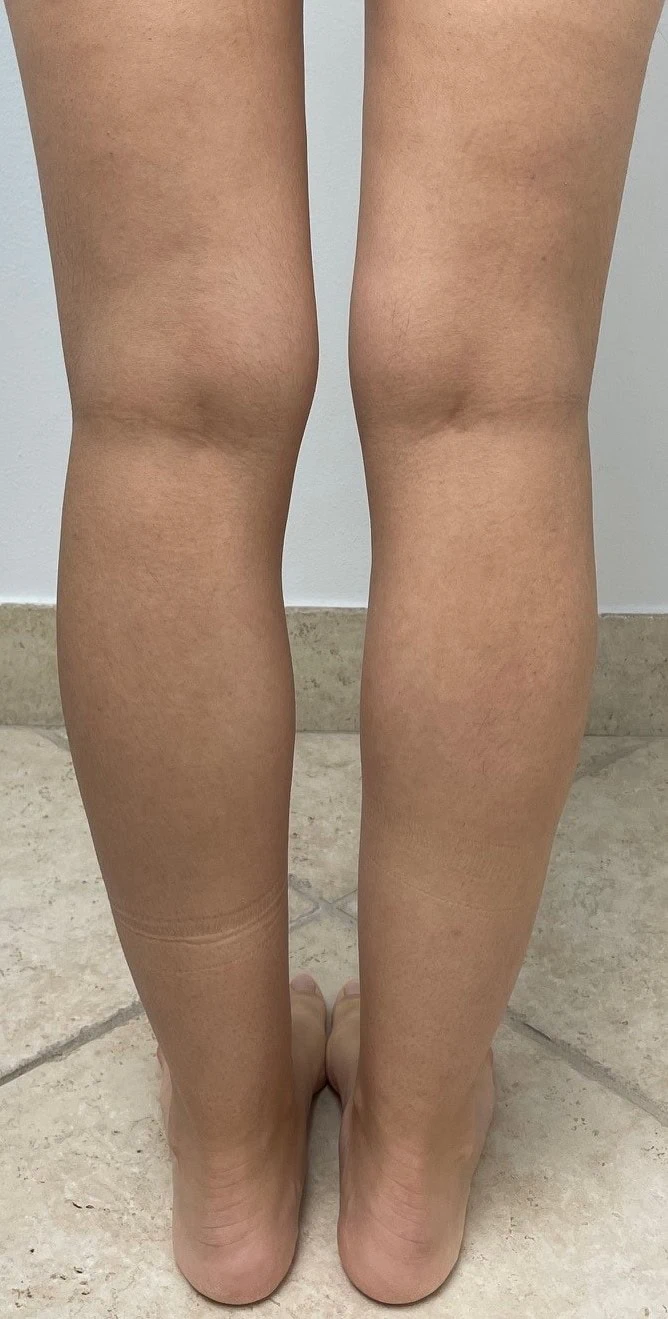 Calf Ankle Liposuction Before Three by Dr Grossman in NY US