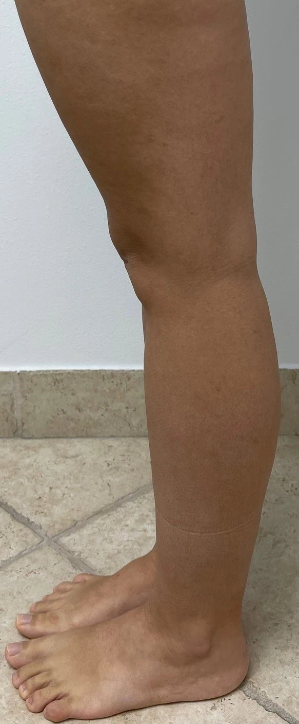 Calf Ankle Liposuction Before Two by Dr Grossman in NY US