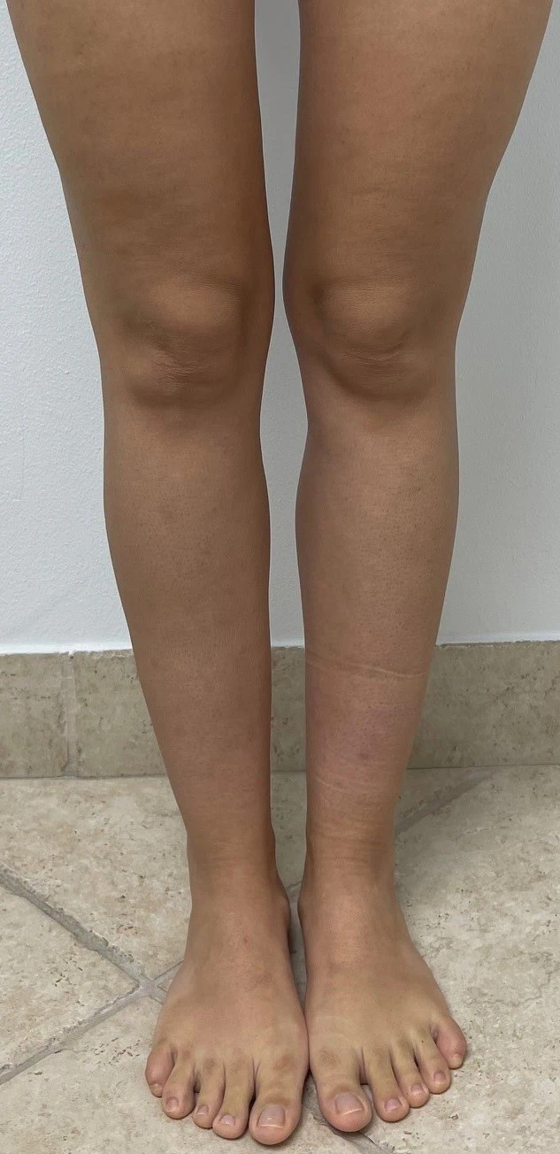 Calf Ankle Liposuction Before by Dr Grossman in NY US