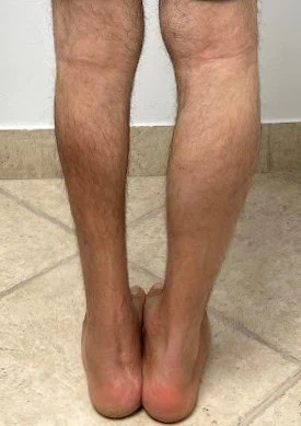 Calf Augmentation Before by Dr Grossman in NY US