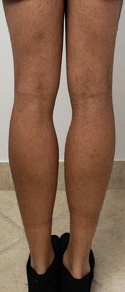 Calf Augmentation With Fat After Back Legs 6 by Dr Grossman in NY US