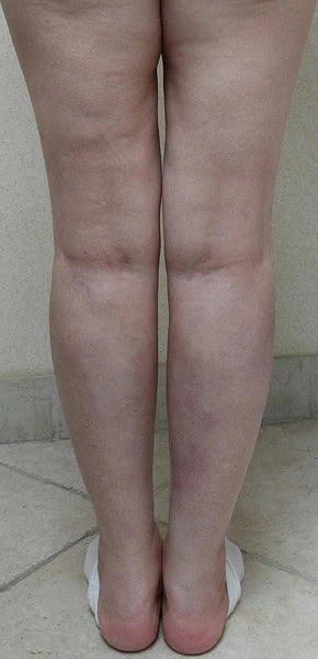 Calf Augmentation With Fat After Back Legs 8 by Dr Grossman in NY US