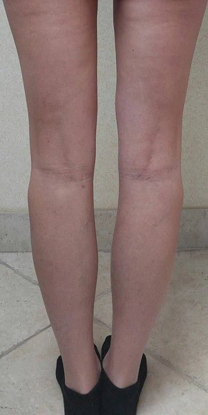 Calf Augmentation With Fat After Back Legs Full by Dr Grossman in NY US