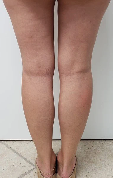 Calf Augmentation With Fat After Back Legs by Dr Grossman in NY US