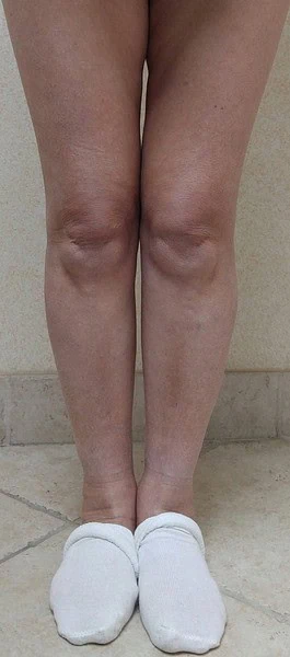 Calf Augmentation With Fat After Front Legs 7 by Dr Grossman in NY US