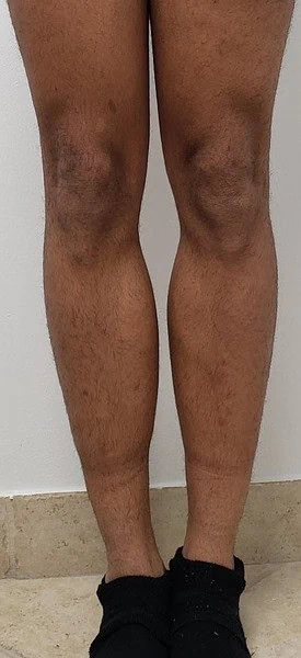 Calf Augmentation With Fat After Front Legs Five by Dr Grossman in NY US