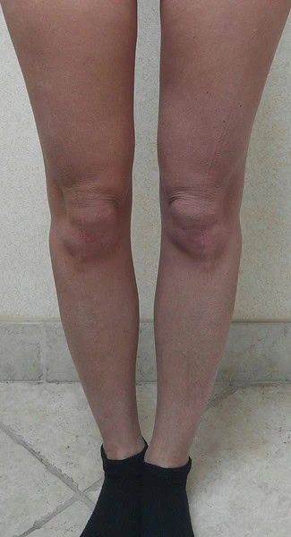 Calf Augmentation With Fat After Front Legs Full by Dr Grossman in NY US