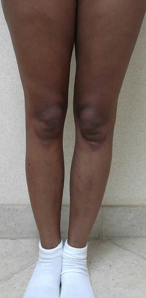 Calf Augmentation With Fat After Front Legs Three by Dr Grossman in NY US