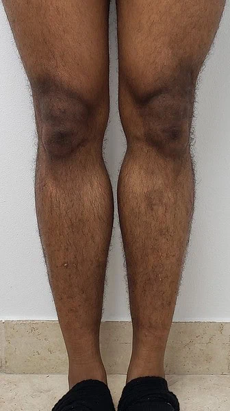 Calf Augmentation With Fat After Front Legs Two by Dr Grossman in NY US