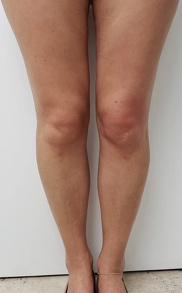 Calf Augmentation With Fat After Front Legs by Dr Grossman in NY US