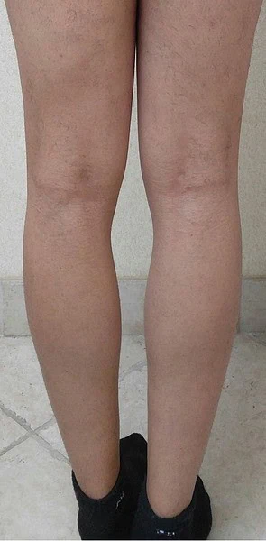 Calf Augmentation With Fat Before Back Legs 6 by Dr Grossman in NY US