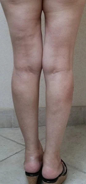 Calf Augmentation With Fat Before Back Legs 8 by Dr Grossman in NY US